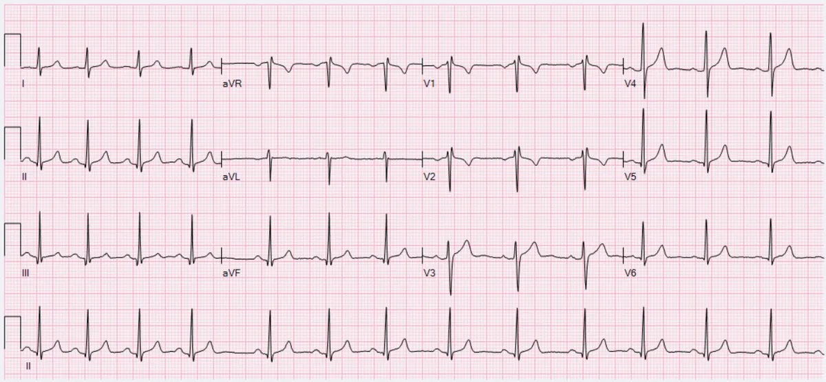 ECG Sinus Arrhythmia 79 bpm